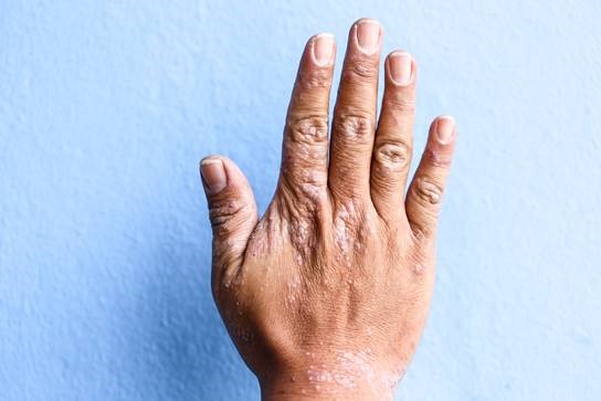 psoriase2017banner.jpg