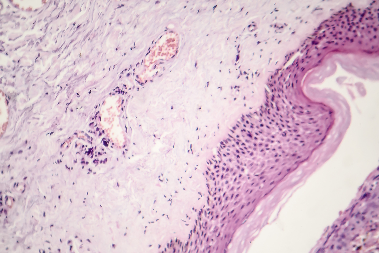 com-a-palavra---carcinoma.jpg