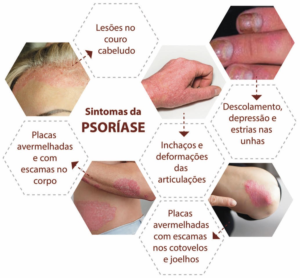 Psoríase - Sociedade Brasileira de Dermatologia