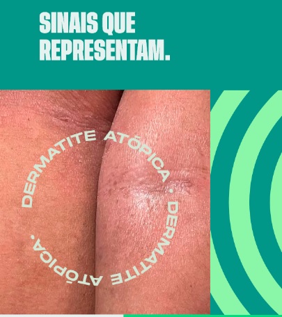 Dermatite-imagem1.jpg