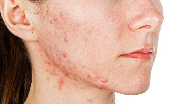 acne.jpg